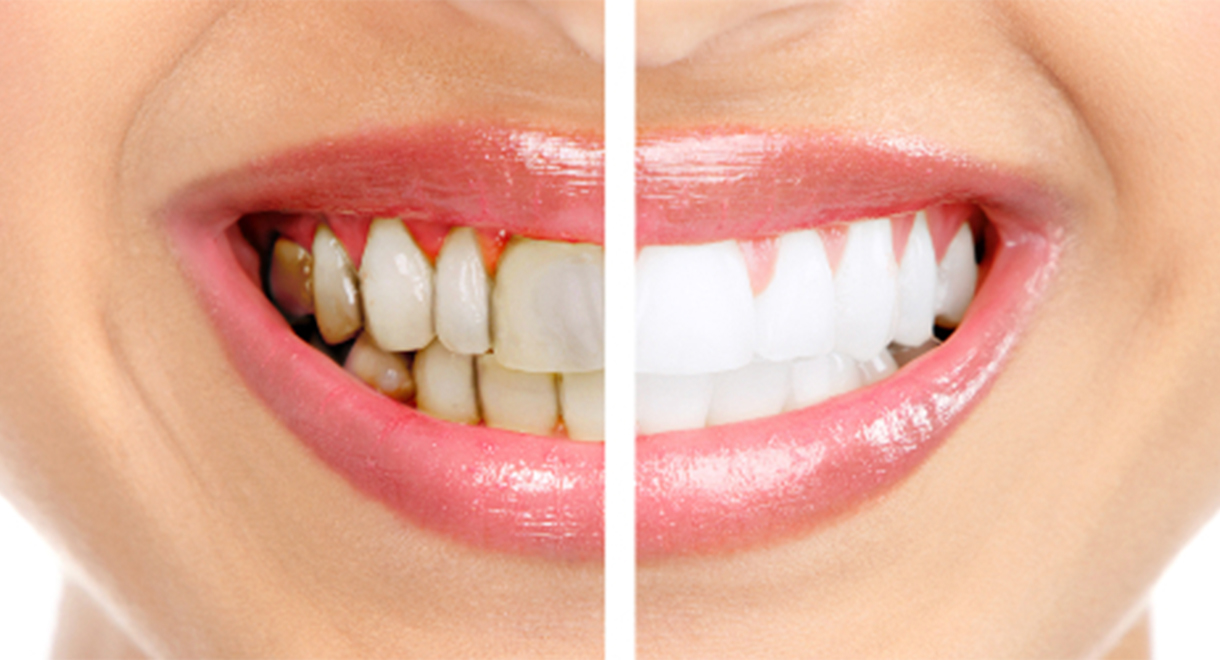 The Truth about Teeth Whiteners - Should You Be Using Them?